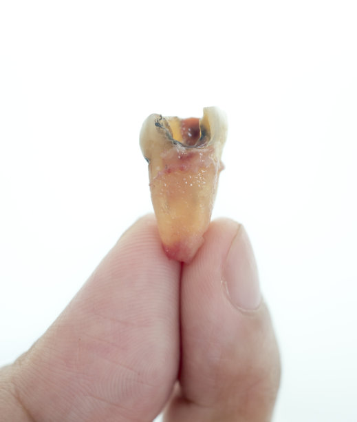 人手上的龋齿图片下载