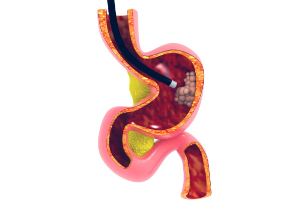 内窥镜检查图片下载