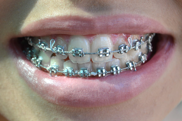 带牙套的牙齿图片下载