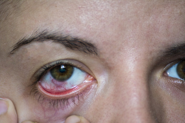 红眼或结膜炎图片下载