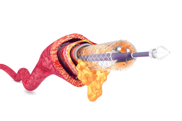 气球充气支架。解剖的概念图片下载