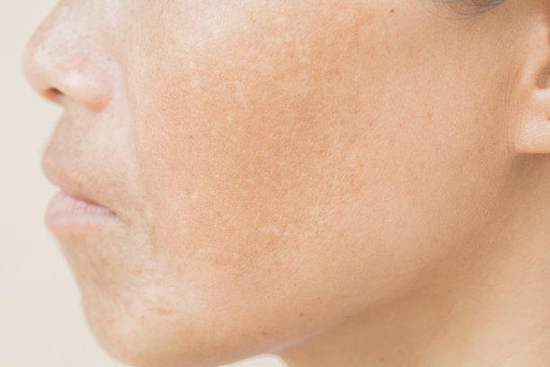 脸上的雀斑图片下载