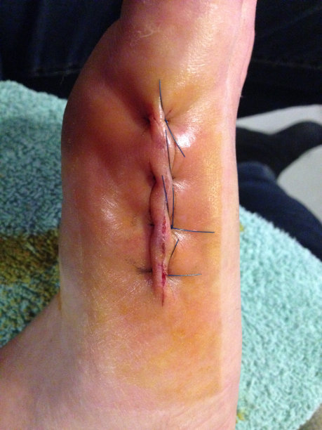 踝关节手术意外包扎足矫形理疗如何护理图片下载