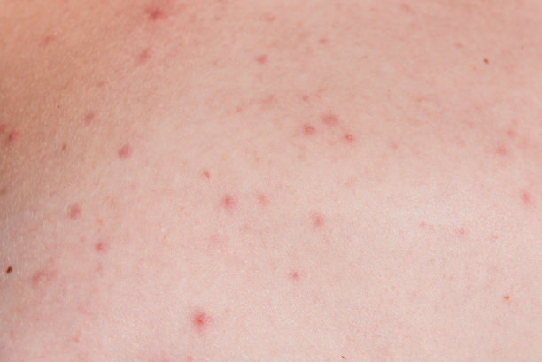 皮肤上的痤疮-医学，化妆品的背景，护肤的概念图片下载