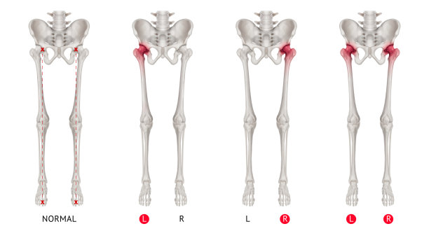 正常腿骨或中立位腿骨前视图关节炎髋关节疼痛区红色突出物- 3d医学插图-人体解剖学和医学概念-白色背景图片下载