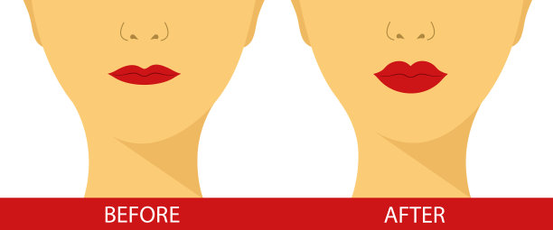 前后嘴唇填充注射。美容整形。图片下载