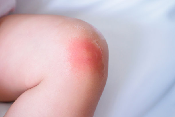 婴儿膝盖处被蚊子叮咬引起的皮疹和红斑过敏图片下载
