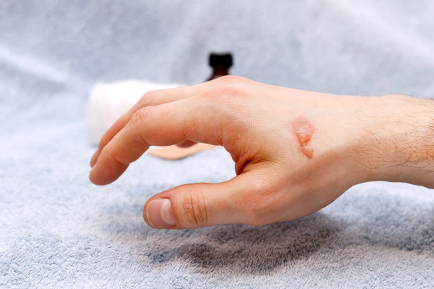 在医院的时候手上有灼伤水泡图片下载