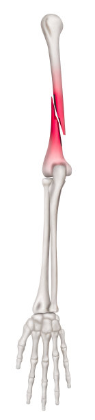 肱骨骨折或断臂疼痛区域红色高亮-完全移位骨折类型前视图- 3D医学和生物医学插图-人体解剖学医学概念-白色背景。图片下载
