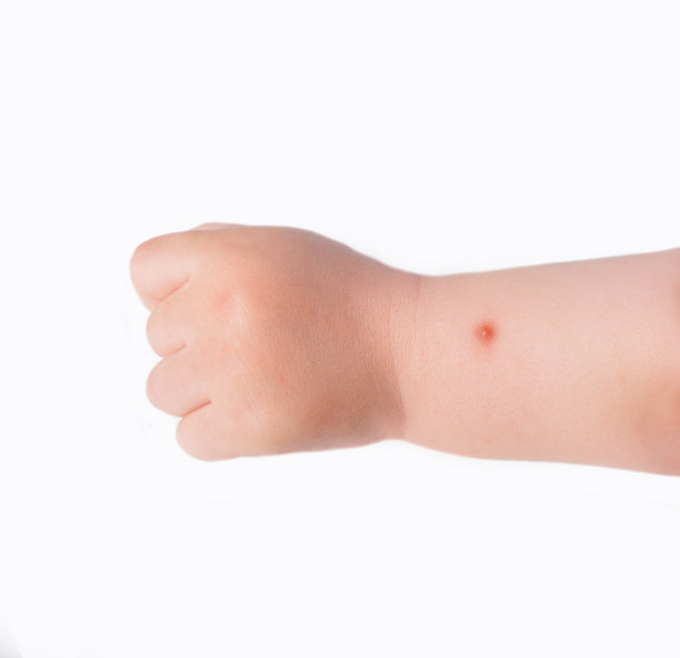 蚊子咬人图片下载