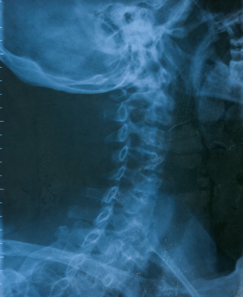 颈部x光片图片下载