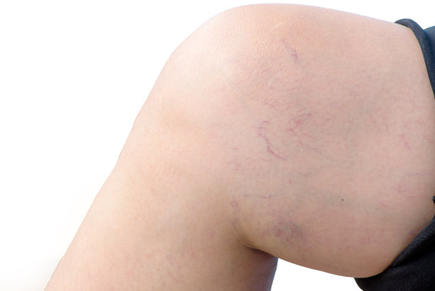 女性腿部有静脉曲张和毛细血管，医疗保健理念图片下载