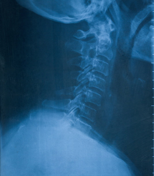 颈部x光片图片下载