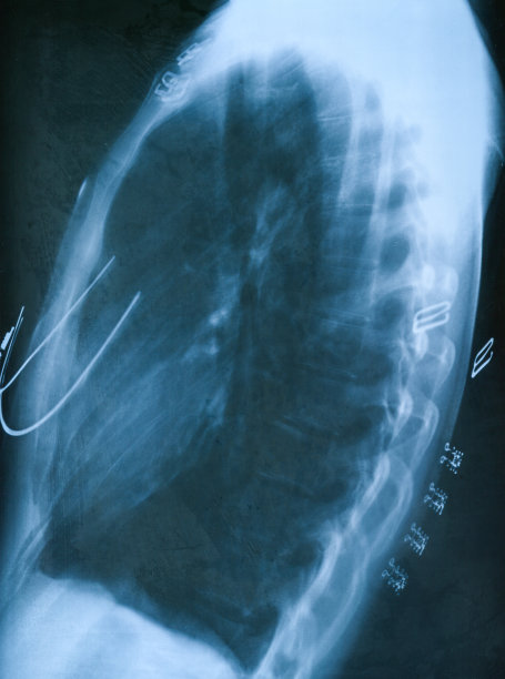 胸廓侧x线片图片下载