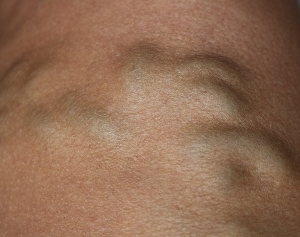 静脉曲张图片下载