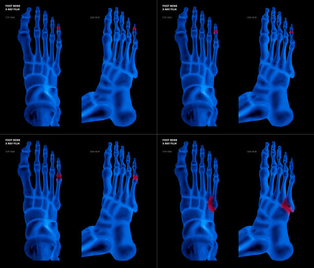 集合性关节炎小脚趾关节足骨的x线片不同疼痛部位的红色突出物-前部和侧视图- 3d医学和生物医学插图-医学概念-蓝色调图片下载