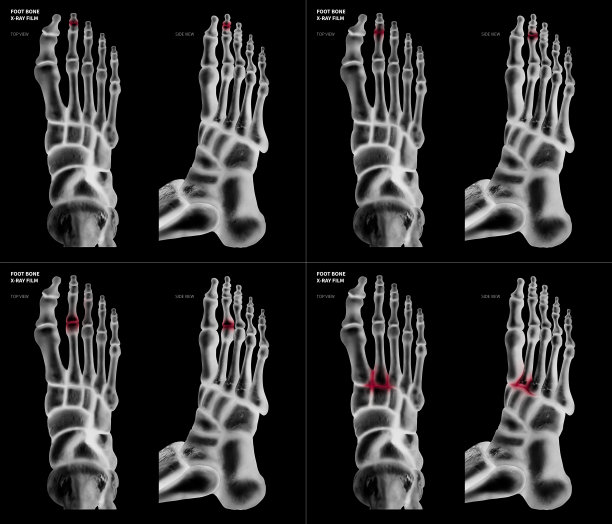 集合性关节炎长趾关节足骨不同疼痛部位的x线片-前侧视图- 3d医学和生物医学图片-医学概念-孤立的黑色背景图片下载