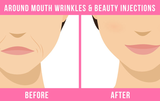 整容手术肉毒杆菌图片下载