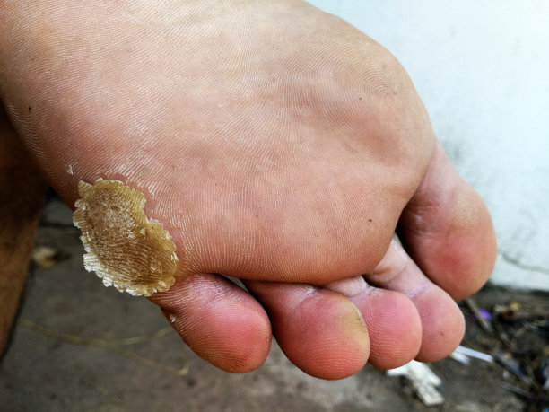 脚死皮图片下载