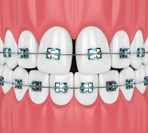 牙齿的发散牙缝和牙套的3d渲染图片下载