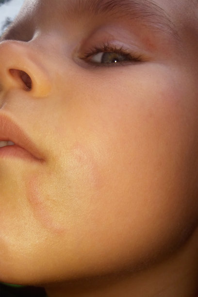 男孩的脸颊上有红肿的咬痕图片下载