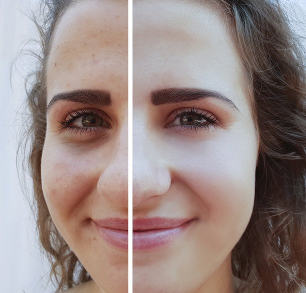 美丽的女孩皱纹，脸上的痤疮手术前后图片下载