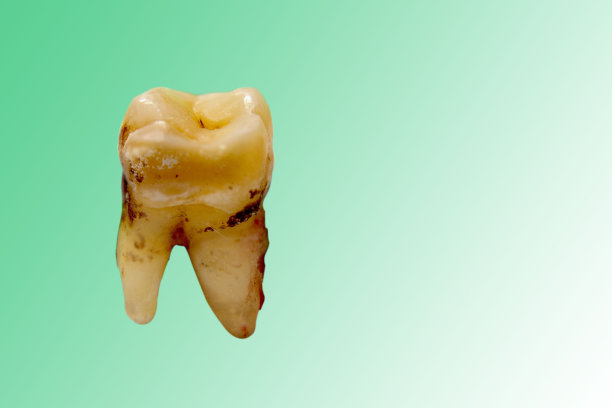 由于牙痛和石灰石造成的蛀牙图片下载