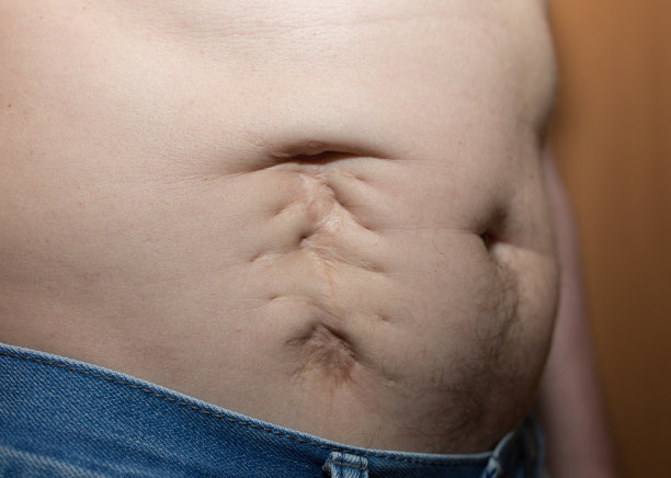 阑尾炎手术后，这个男人肥胖的腹部留下了难看的疤痕。胃上的瘢痕疙瘩。医疗疾病照片。图片下载