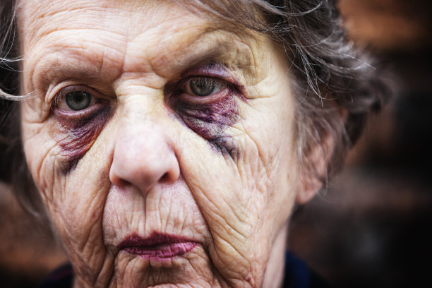 一位满脸淤青的资深女士看起来很不高兴图片下载