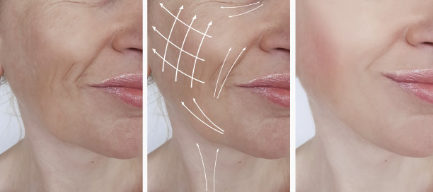 女性面部皱纹矫正前后程序，箭头图片下载