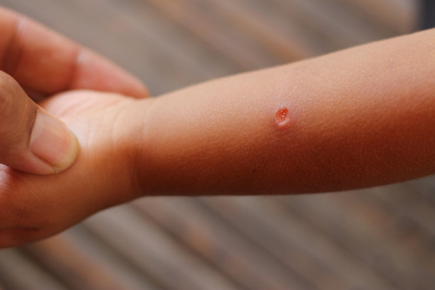 婴儿手臂上有伤口后被虫子咬伤，伤口在孩子手臂上。图片下载