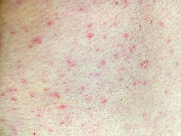 女性腹部皮肤红疹的特写图片下载
