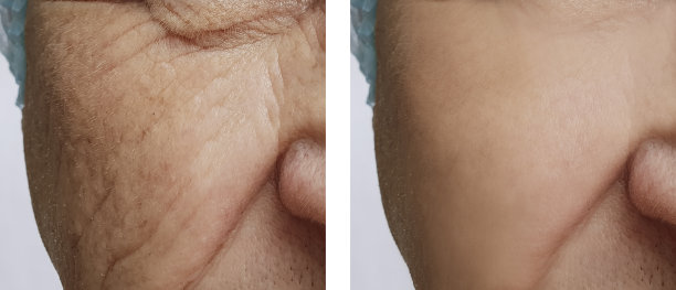 老人脸上皱纹的前后程序图片下载