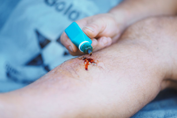 碘治疗人腿上的伤口图片下载