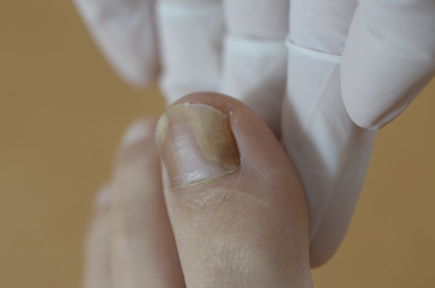 医生检查大脚趾甲。趾甲感染真菌图片下载