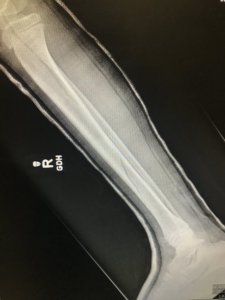 腿部胫骨骨折x线照片图片下载