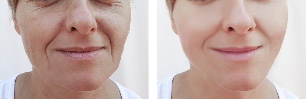 女人皱纹面部治疗前后图片下载