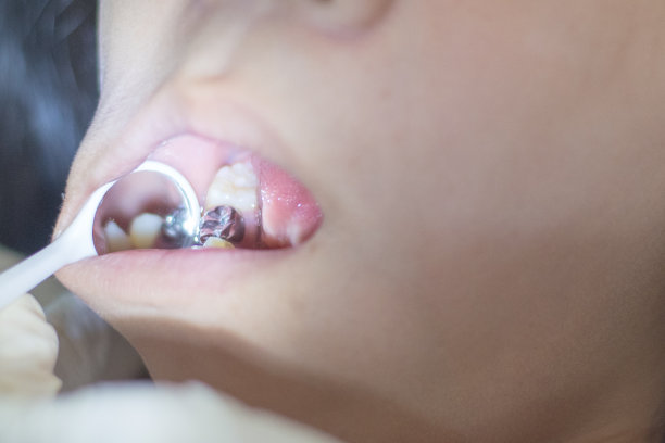 用银汞合金做牙冠，用牙科医生的手，用镜子和器械清洁牙齿。亚洲女童牙齿密封胶图片下载