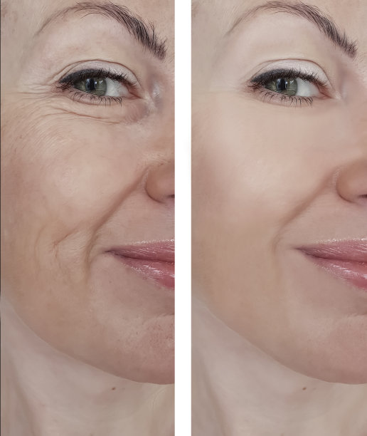 女人脸部皱纹的前后程序图片下载