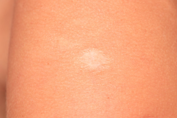 皮肤上的疫苗疤痕图片下载