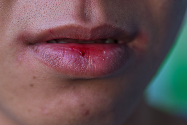 生病的、开裂的、受损的组织。嘴唇干裂，口干，特写时嘴唇干裂，脱水，图片下载