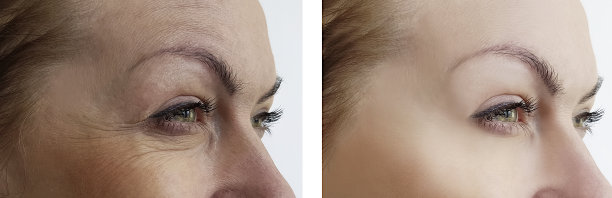 手术前后的女孩皱纹素材图片