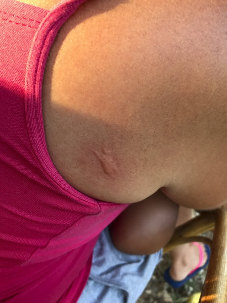 有皮肤过敏的妇女的肩膀图片下载