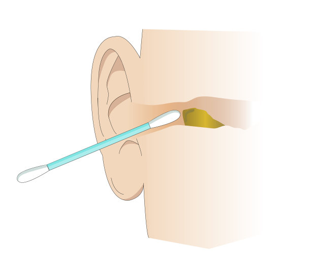 用棉签清洁耳道的插图。清洁耳垢和个人护理的工具。去除耳垢。图片下载