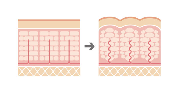 正常皮肤与脂肪团皮肤对比图(无文字)素材图片