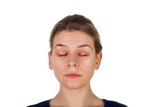 睑裂-眼睑感染图片下载