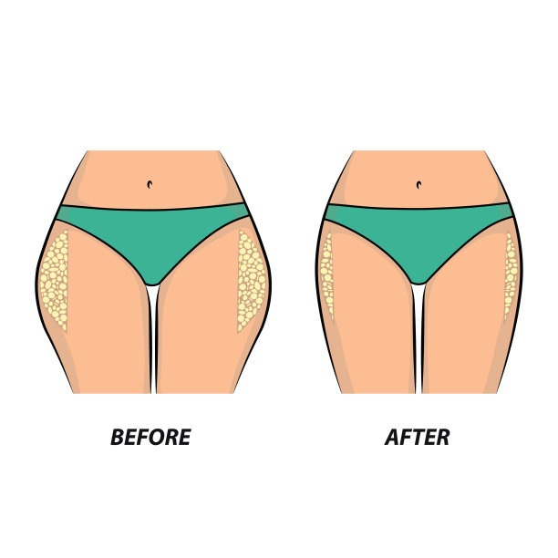 女人的臀部有脂肪团。图片下载