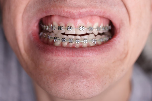 金属矫正牙套对弯曲丑陋的牙齿近距离。丑陋的微笑。牙科概念，医学对齐牙齿，托槽矫正医生图片下载