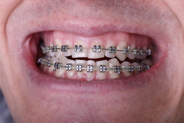 金属矫正牙套对弯曲丑陋的牙齿近距离。丑陋的微笑。牙科概念，医学对齐牙齿，托槽矫正医生图片下载