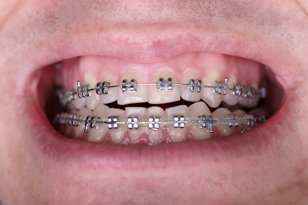 金属矫正牙套对弯曲丑陋的牙齿近距离。丑陋的微笑。牙科概念，医学对齐牙齿，托槽矫正医生图片下载